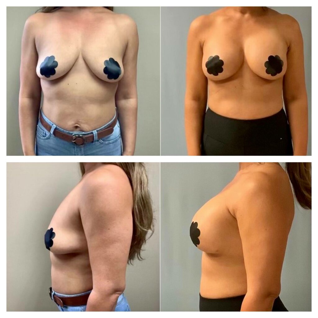 Natural-Looking Breasts
