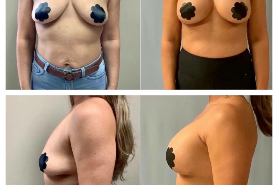 Natural Breast Augmentation