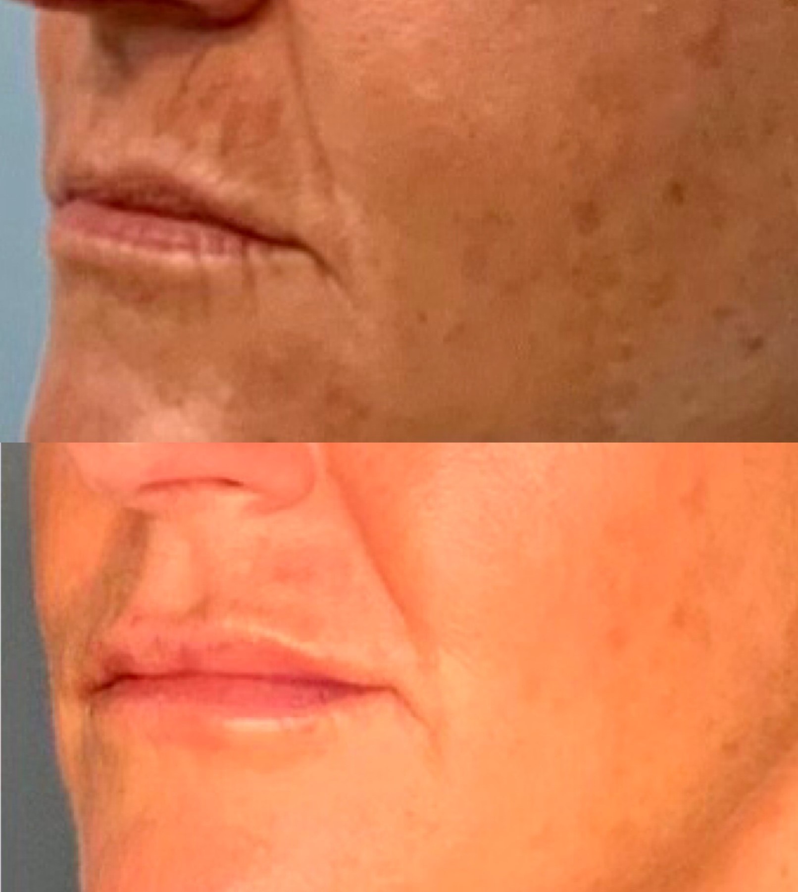 Natural Fat Transfer to the Lips