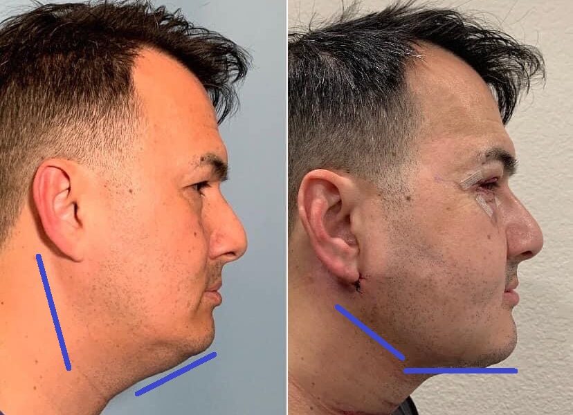 Lower Face and Neck Liposculpture