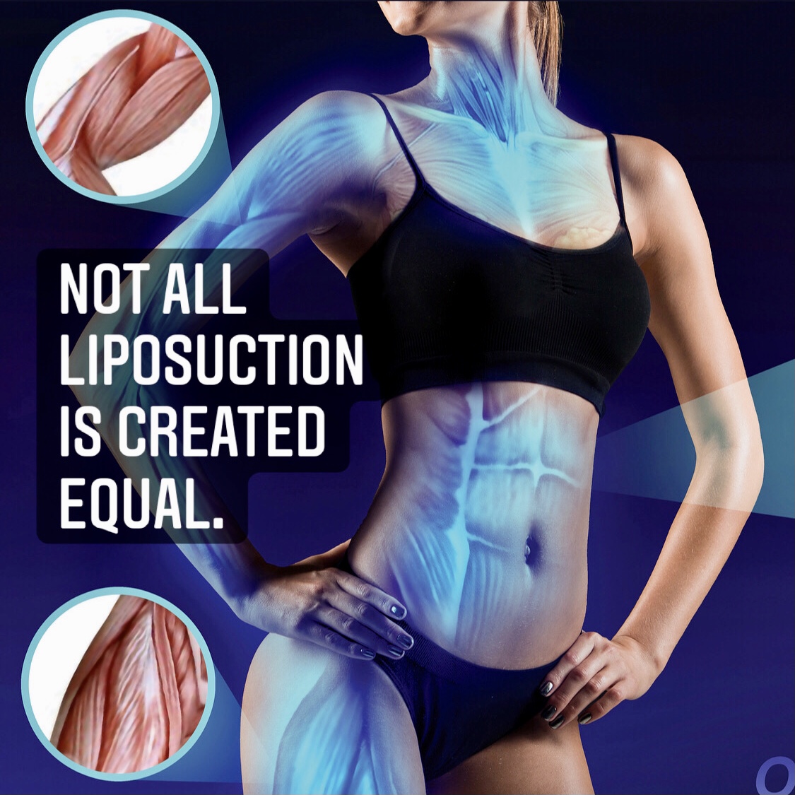 Not All Liposuction is Created Equal