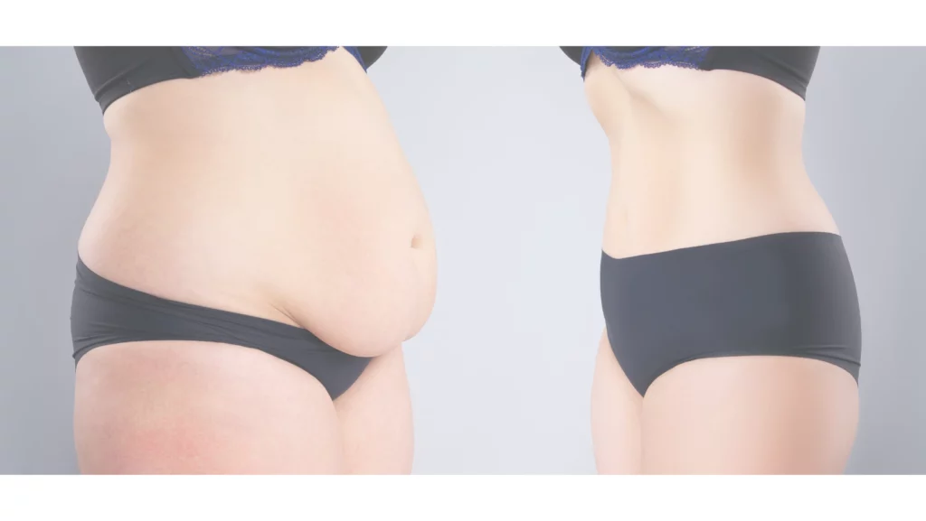 dr cyr - Body Contouring After Weight Loss