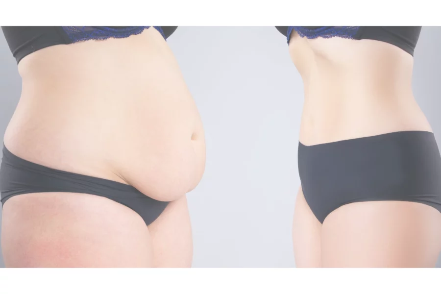 dr cyr - Body Contouring After Weight Loss