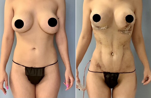 Breast Lift & OrthoSculpting