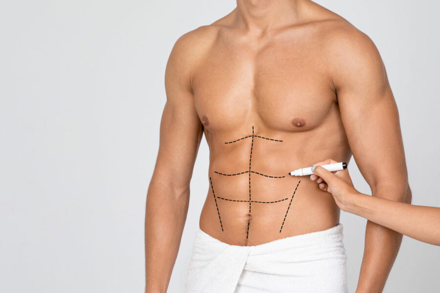 Belly Fat Liposuction on Men