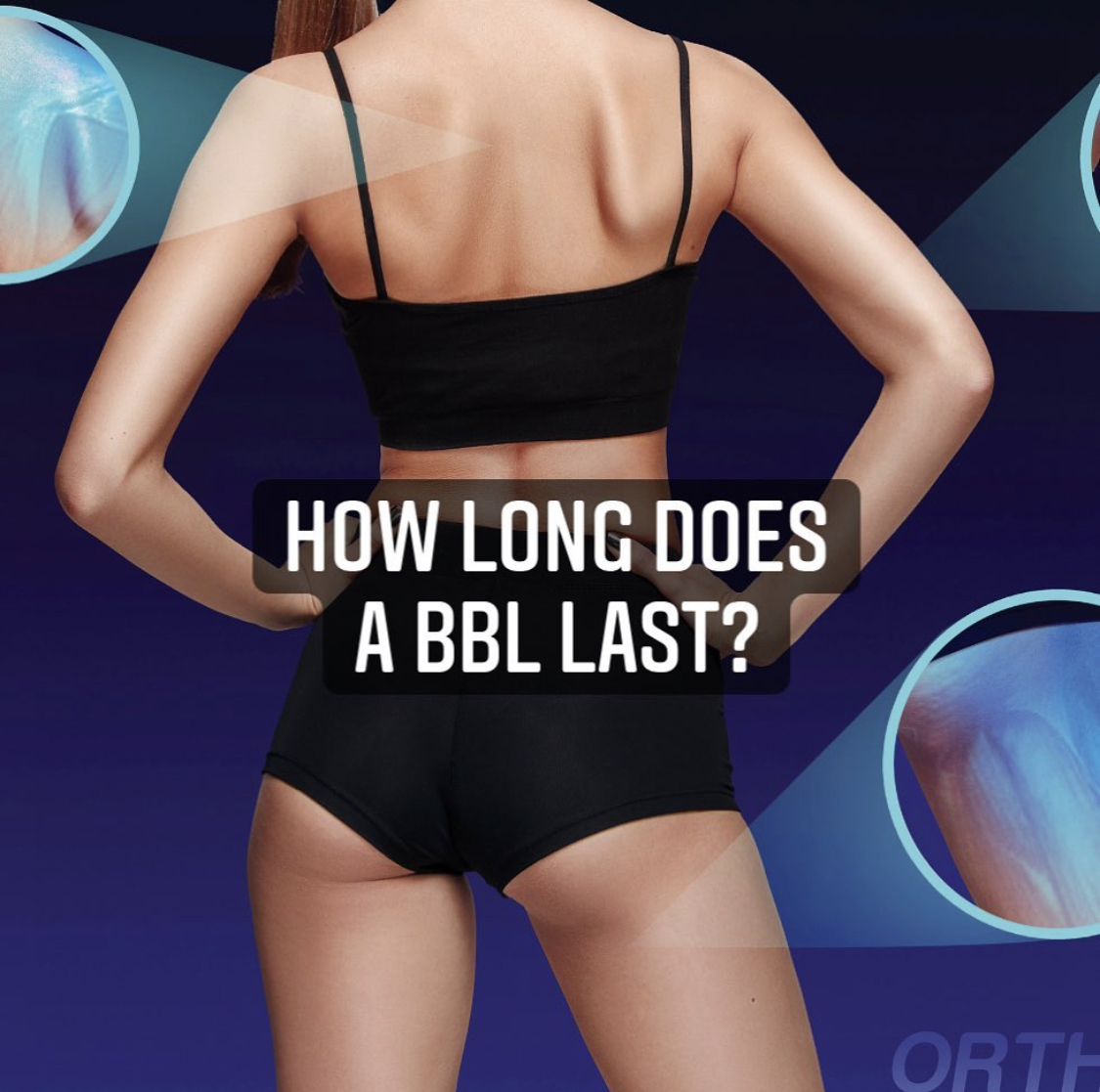 How Long Does a BBL Last?
