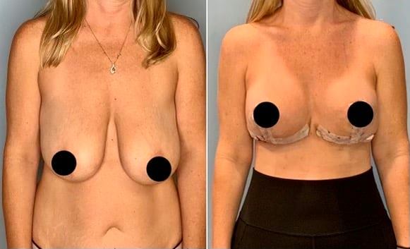 Breast Lift with Reduction