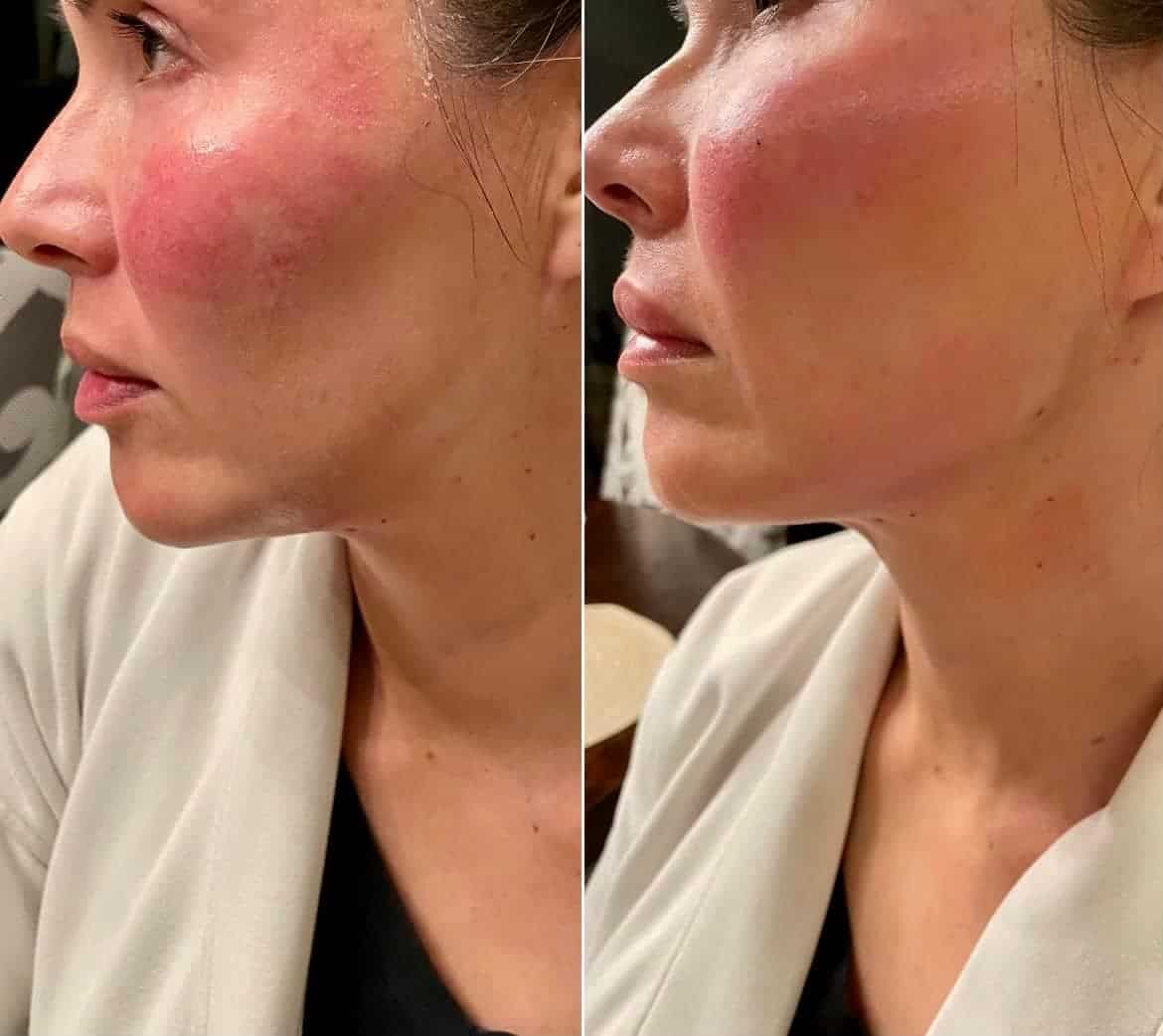 Amazing Jawline Filler Results!