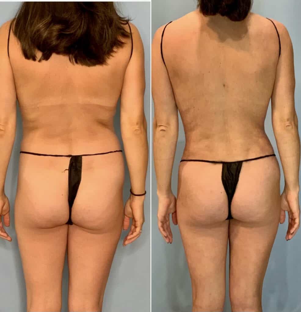 Before & After: Skinny BBL - Body Sculpting with Orthosculpt