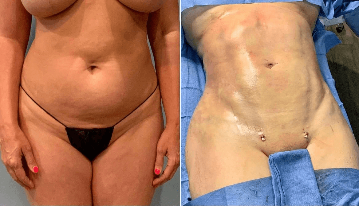 Body Sculpting with Orthosculpt