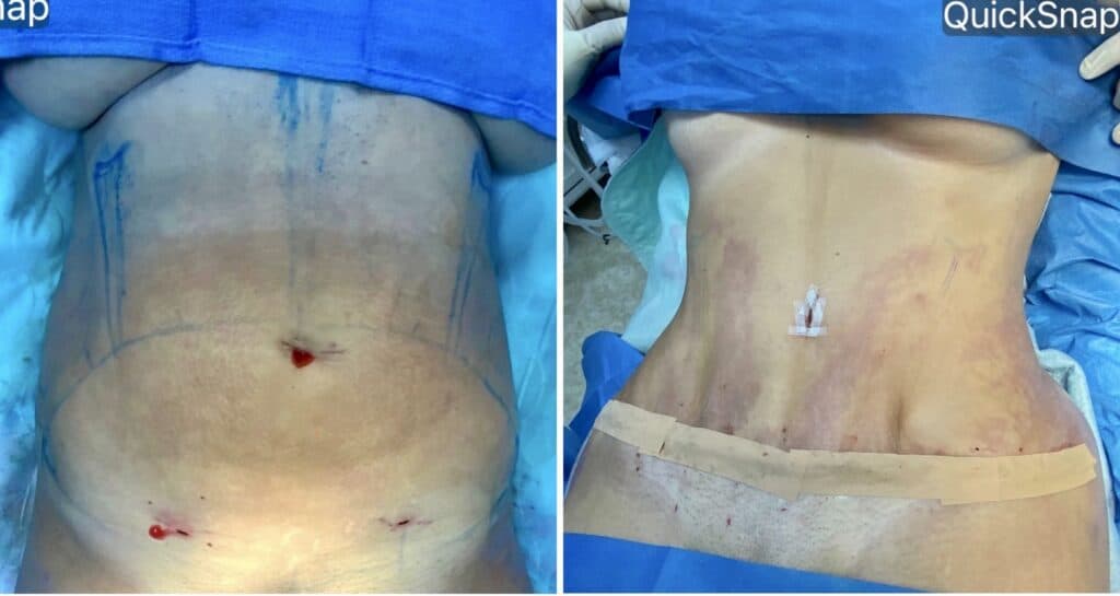 Before &#038; After: OrthoSculpt Abdominoplasty