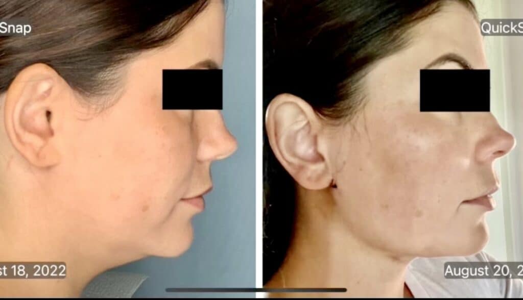 Before &#038; After: Submental OrthoSculpt