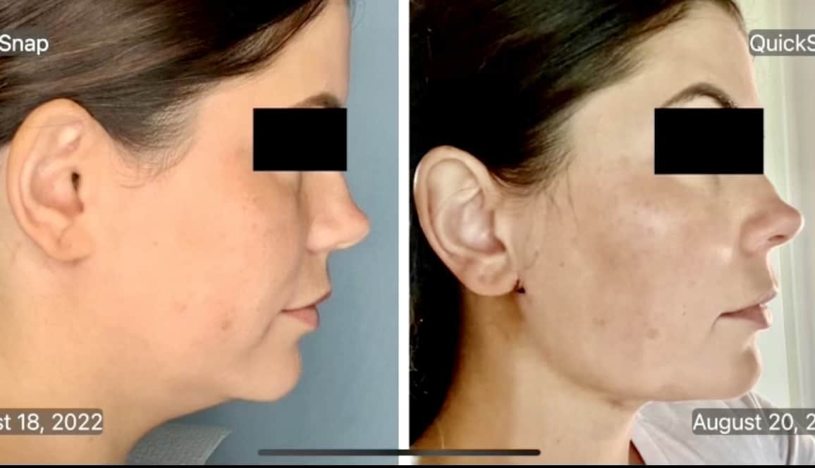 Before & After: Submental OrthoSculpt