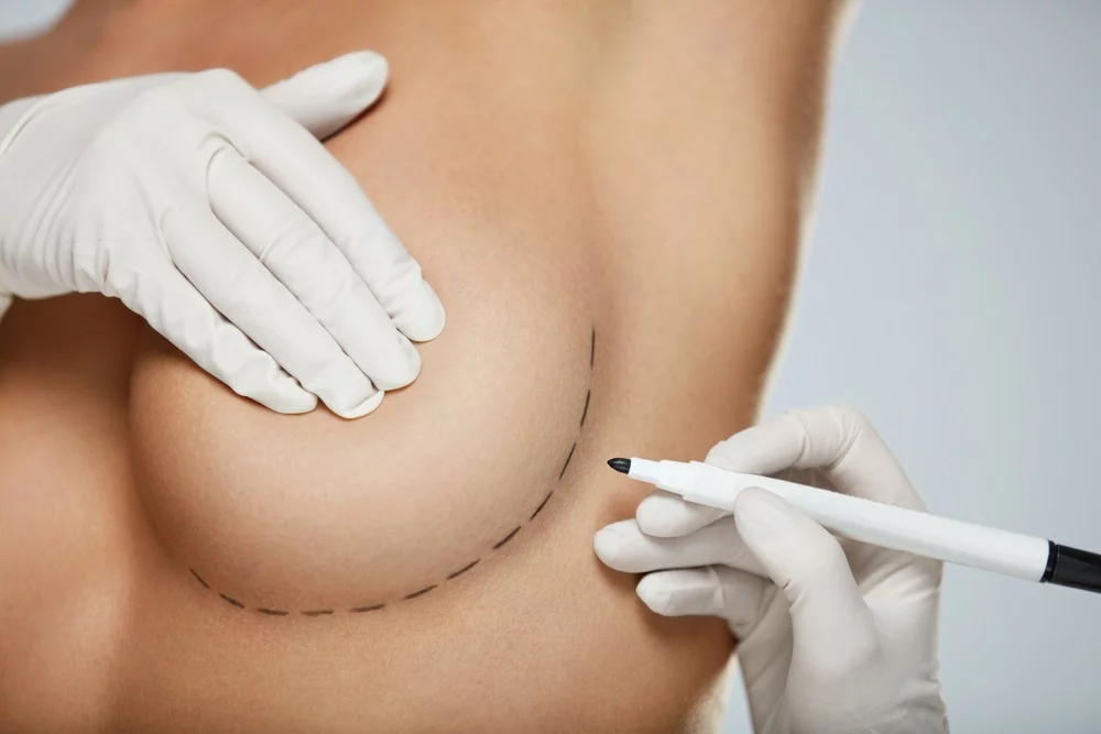 Revolution in Breast Augmentation: Fat Transfer to Breasts