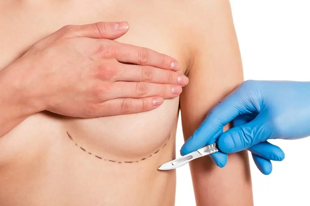 Your Guide to Breast Implant Removal and Recovery