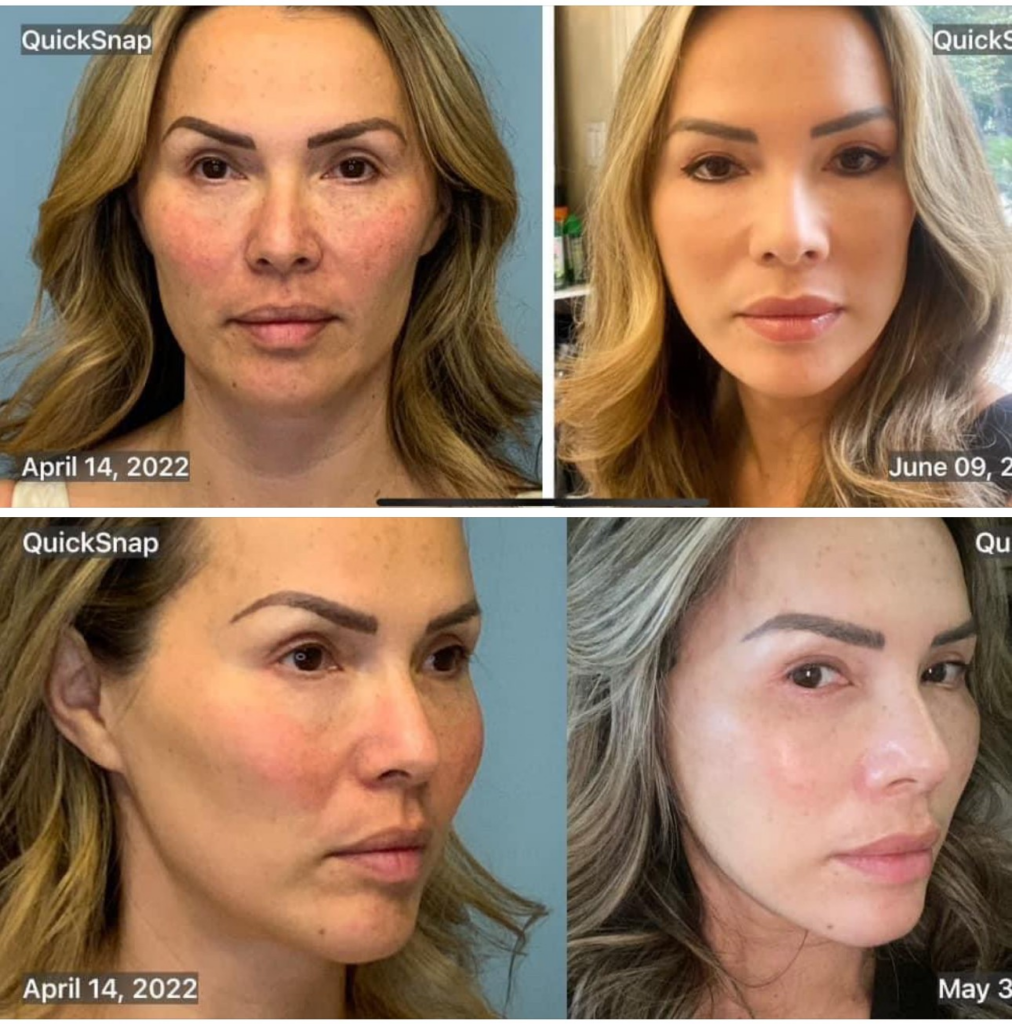 Deep Plane Facelift - Body Sculpting with Orthosculpt