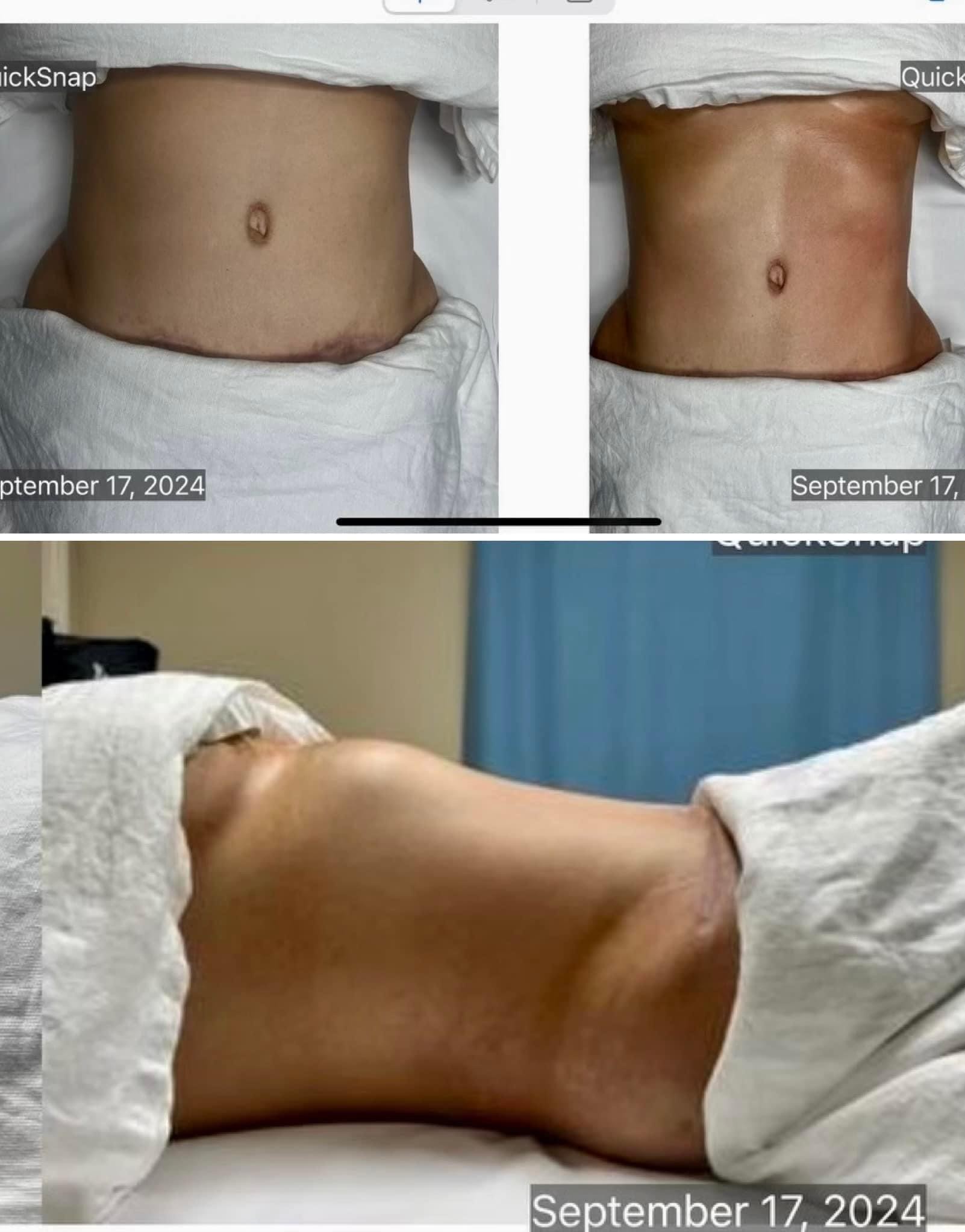 Available Now: Cavi-Lipo Body Sculpting