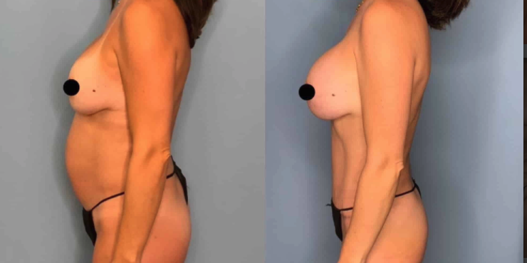 Mommy makeover Houston - tummy tuck 
