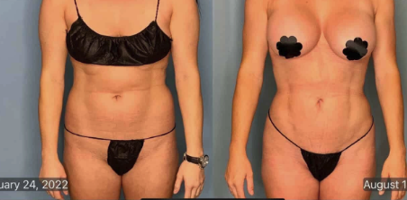 Mommy Makeover Houston - liposuction 