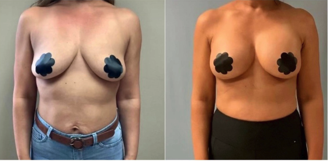 Mommy makeover Houston - breast lift with augmentation 