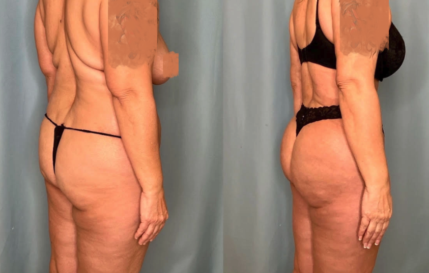 Mommy Makeover Houston-BBL 