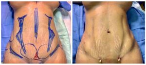 Pre-Operative Workup