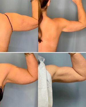 OrthoSculpt of the Arms