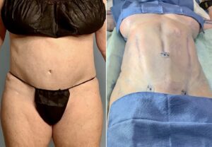 Body Sculpting with Orthosculpt